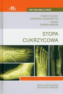 Stopa cukrzycowa Stopa cukrzycowa